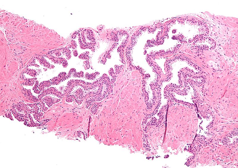 Hyperplasia vs Neoplasia