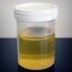 What is the Difference Between Amniotic Fluid and Urine - Pediaa.Com