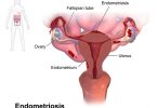 What is the Difference Between Endometriosis and Adenomyosis
