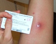 Main Difference - HA-MRSA vs CA-MRSA