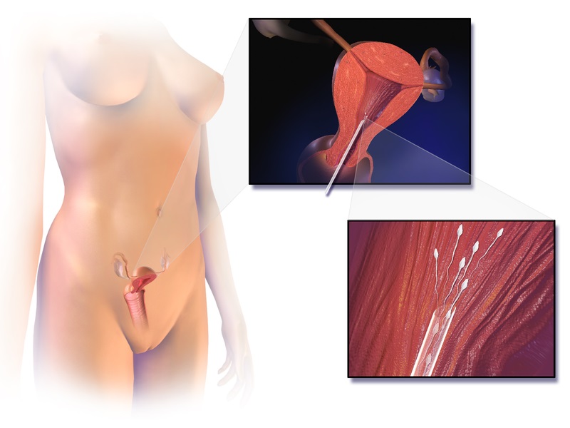 Difference Between Artificial Insemination and in vitro Fertilization