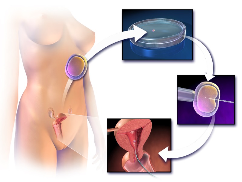 Main Difference - Artificial Insemination vs in vitro Fertilization