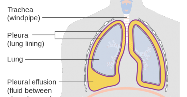 What is the Difference Between Transudate and Exudate Pleural Effusion