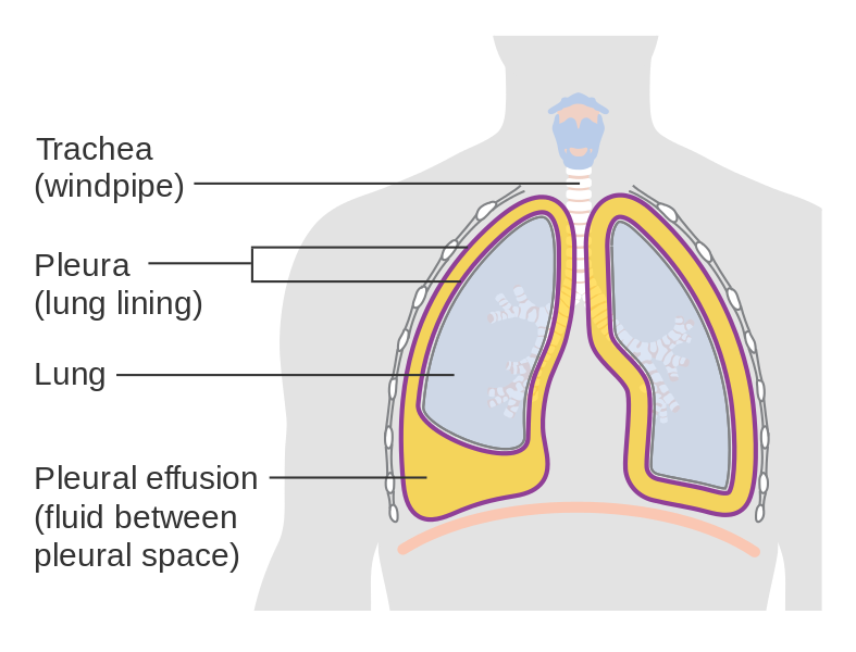 What is the Difference Between Transudate and Exudate Pleural Effusion ...