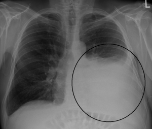 What is the Difference Between Transudate and Exudate Pleural Effusion ...