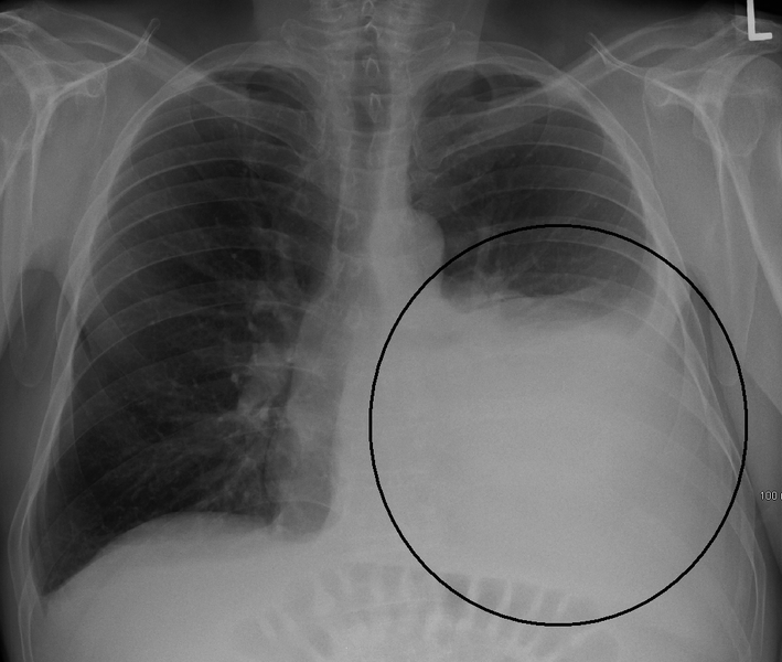Comparing Transudate and Exudate Pleural Effusion