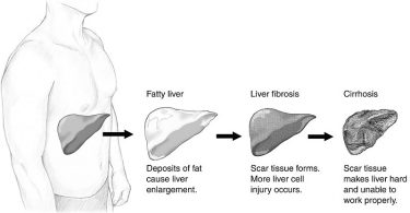 What is the Difference Between NASH and NAFLD