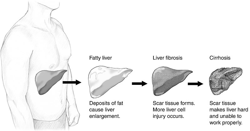 What is the Difference Between NASH and NAFLD