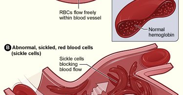Main Difference - Normal Hemoglobin and Sickle Cell Hemoglobin
