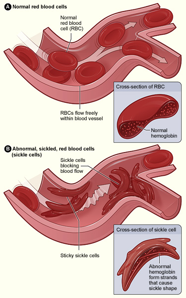 Difference Between Normal Hemoglobin and Sickle Cell Hemoglobin