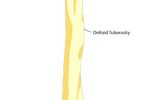 Difference Between Tuberosity and Tubercle