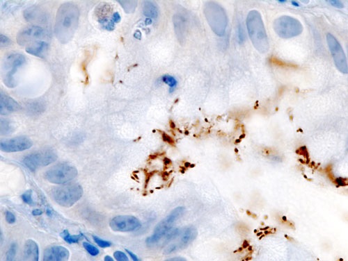 H. Pylori IGG vs IGA
