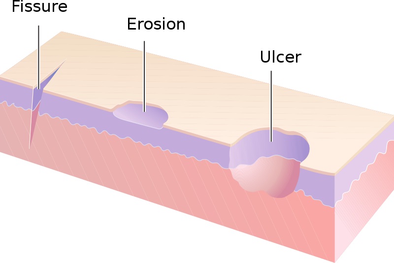 Compare Fissure and Fistula