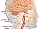 Coronary vs Carotid Artery