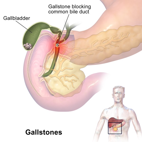 Cholesterol vs Pigment Gallstones