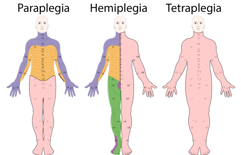 Compare Paraplegia and Tetraplegia - What's the difference?