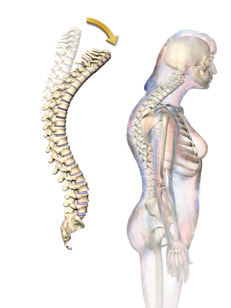 What Is The Difference Between Scoliosis Kyphosis And Lordosis Pediaa Com